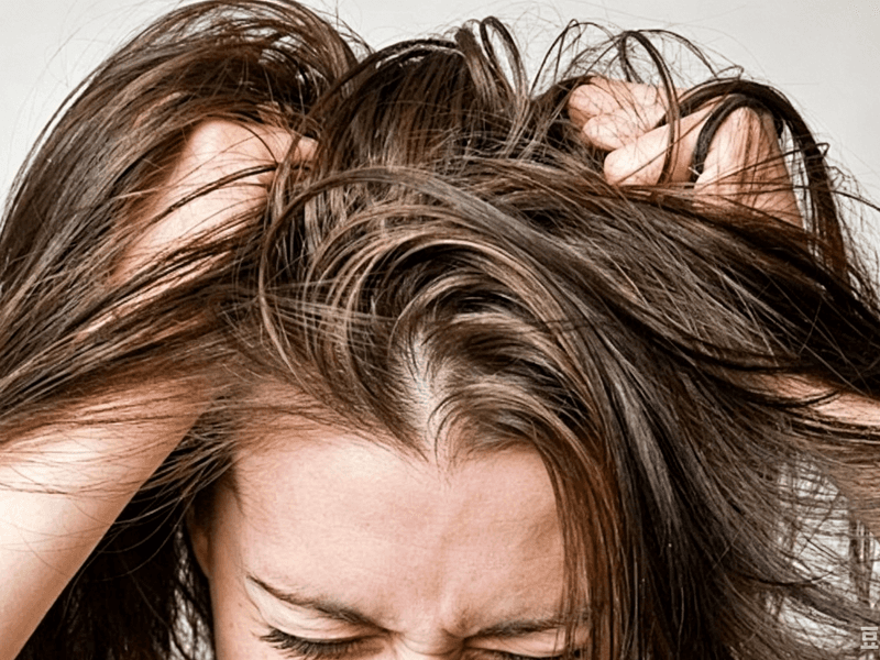 Oily and flaky scalp